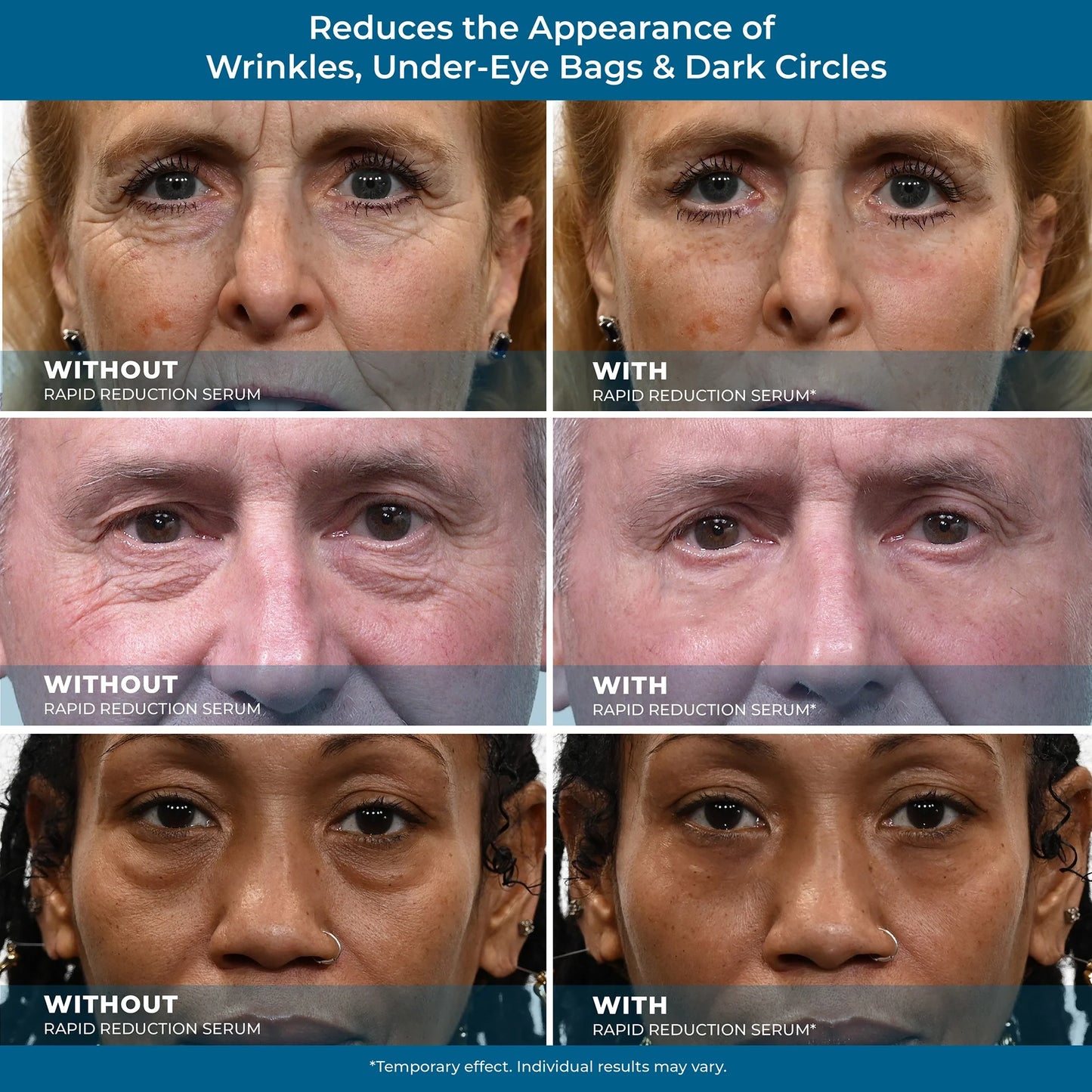 Plexaderm Rapid Reduction Eye Serum - Visibly Reduces Under-Eye Bags, Wrinkles, Dark Circles, Fine Lines & Crow's Feet Instantly, Anti Aging Wrinkle Remover for Face